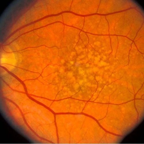 macula degeneratie oog netvlies